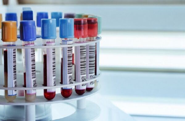 Aseguramiento de la calidad en preanalítica en Hematología y Hemostasia